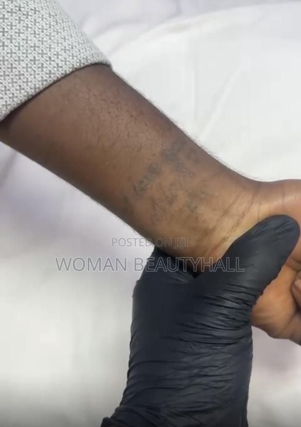 Tattoo Removal · Photo 2