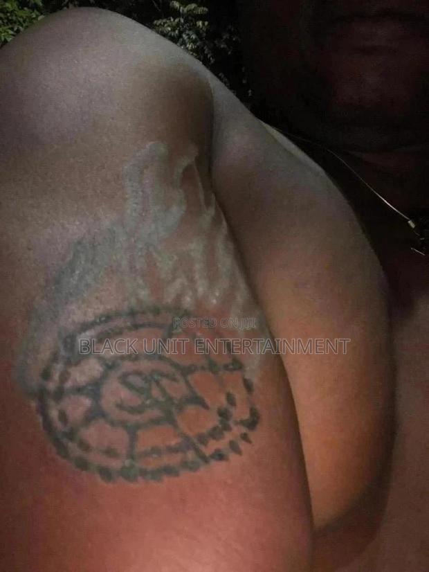 Tattoo Removal