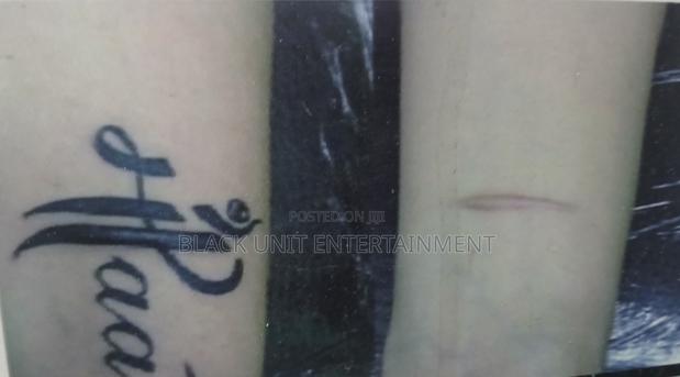 Tattoo Removal · Photo 3