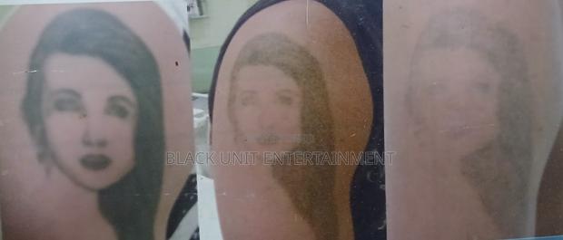 Tattoo Removal · Photo 4