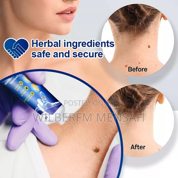 Wart Remover Ointment · Photo 3