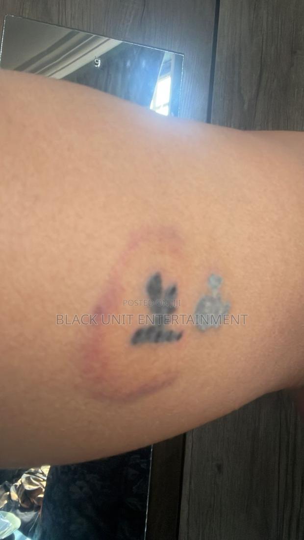 Tattoo Removal · Photo 7
