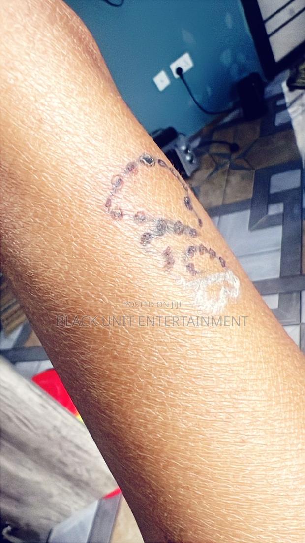 Tattoo Removal · Photo 8