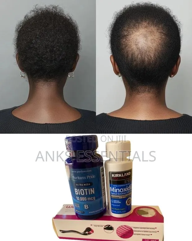 Original Kirkland Biotin Combo – Hair Growth Support · Photo 1