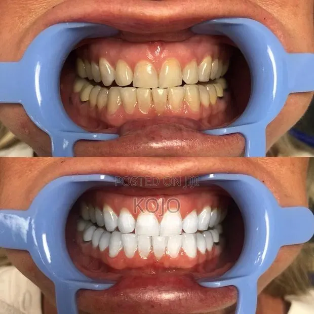Teeth Whitening · Photo 1
