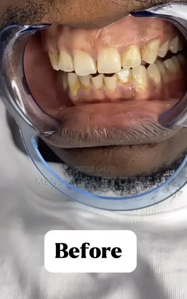 Professional Teeth Whitening · Photo 1