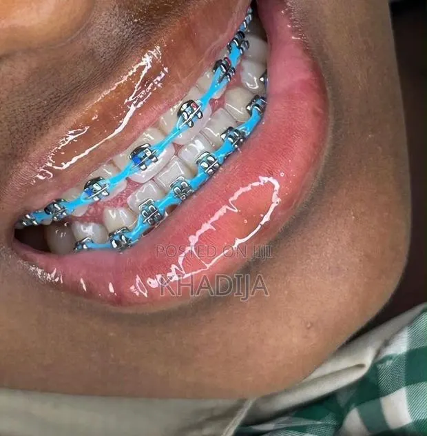 Fashion Braces · Photo 1