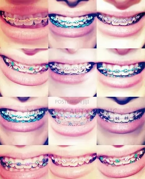 Fashion Braces Available Book Appointment · Photo 2