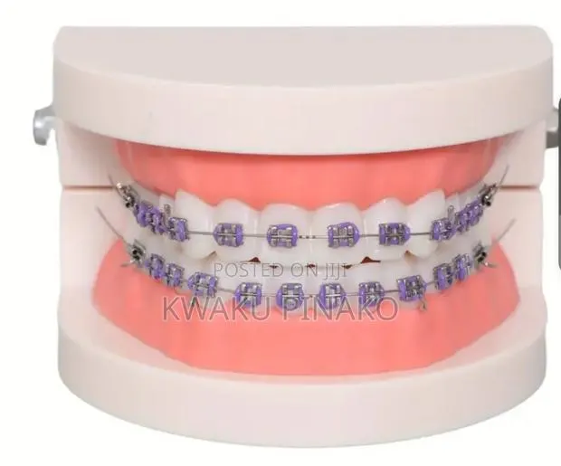 Fashion Braces for-Sale Cool Price · Photo 1