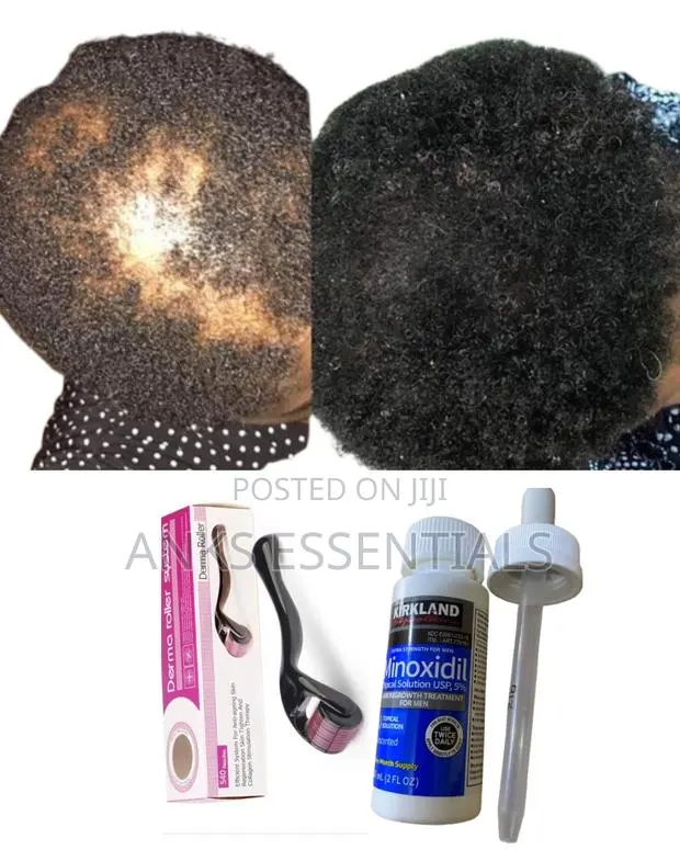 Kirkland Hair Regrowth Oil + Derma Roller for Thicker Hair · Photo 1