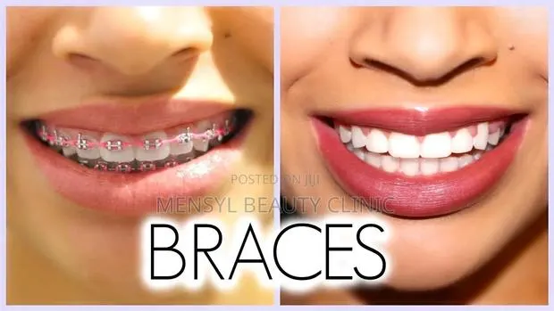 Fashion Braces Available Book Appointment · Photo 1