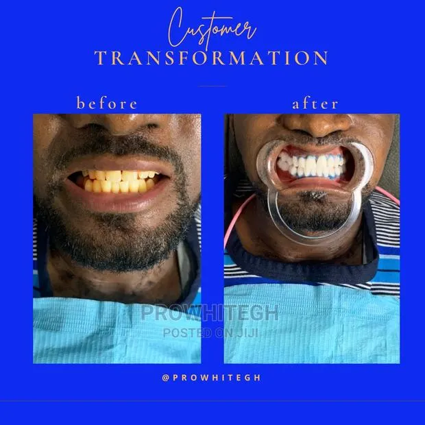 Instant Teethwhitening Service · Photo 1