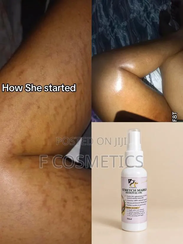 Stretchmarks Oil · Photo 1
