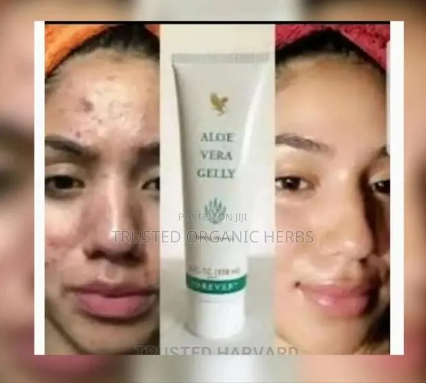 Natural Solution For Pimples Dark Spots And Acne · Photo 1