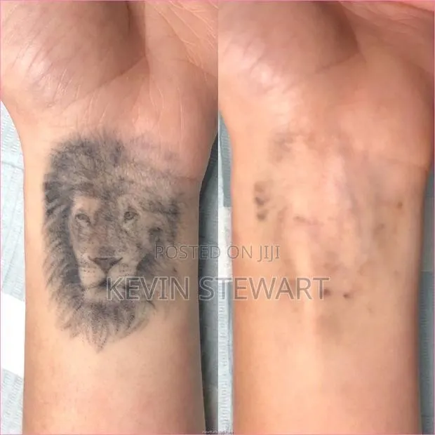 Tattoo Removal,Eye Brows Remove,Black Doll Treatment Etc · Photo 1