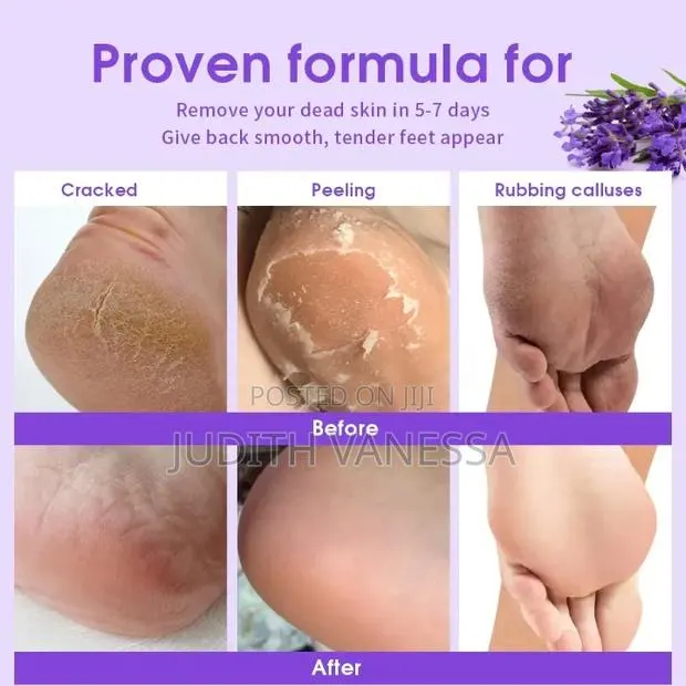 Foot Peel,Exfoliating Foot Mask