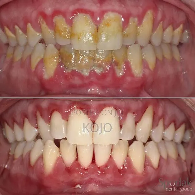 Teeth Cleaning · Photo 1
