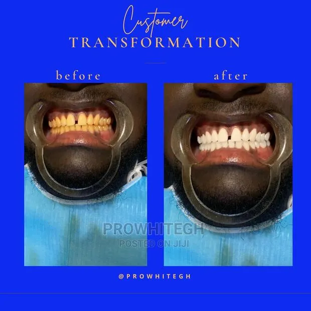 Effective Instant Teethwitening Service · Photo 1