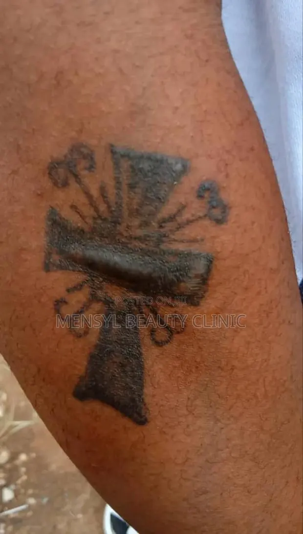 Tattoo Removal · Photo 1