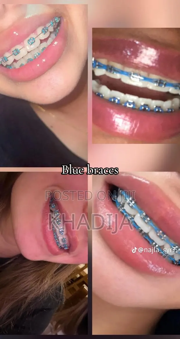 Fashion Braces · Photo 1