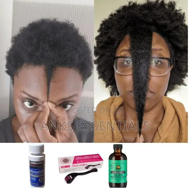 Kirkland Minoxidil, Tea Tree With Derma Roller Combo for Hair Growth · Photo 1